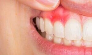 عفونت دندان و مشکلات آن: هر آنچه باید بدانید